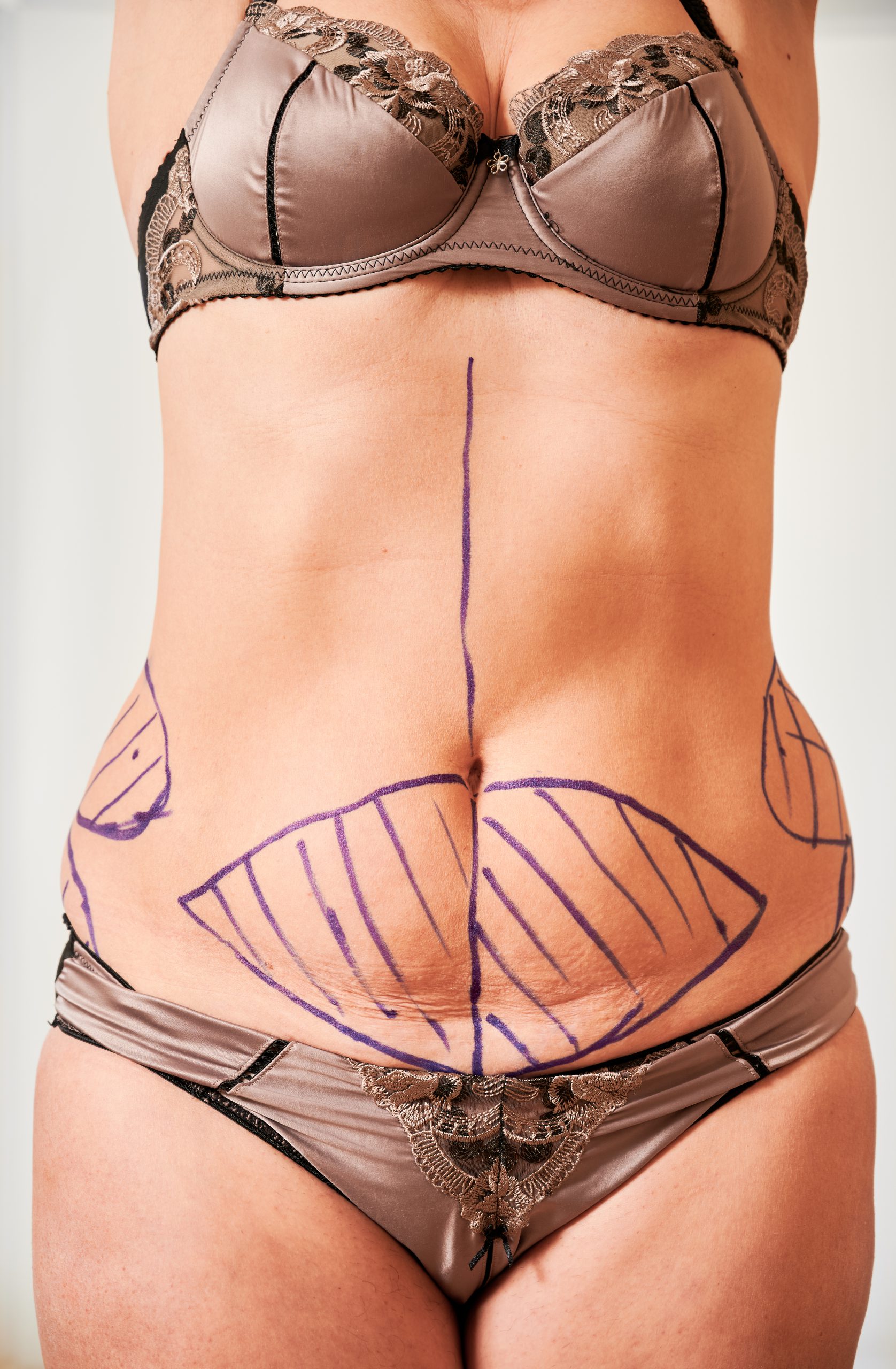 Close up of female patient belly with blue marks for aesthetic surgery. Front view of fat woman in underwear with raised hands demonstrating results of preoperative marking procedure.