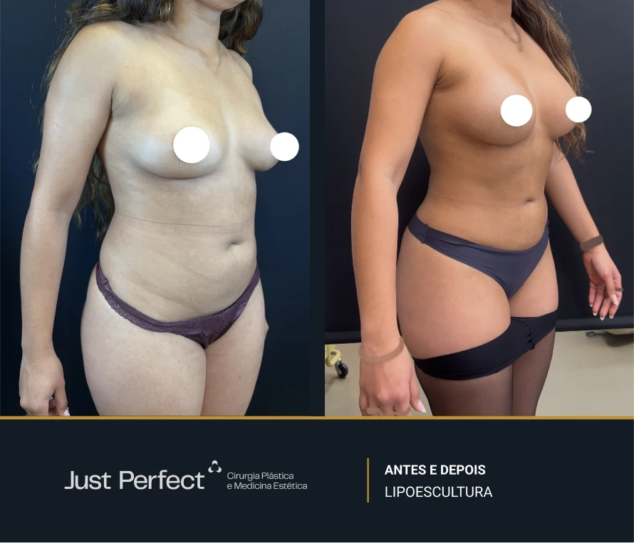 JP_-_antes_e_depois_-_Lipo_1