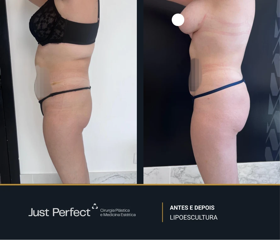 JP_-_antes_e_depois_-_Lipo_10