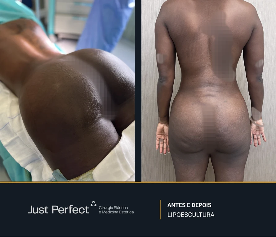 JP_-_antes_e_depois_-_Lipo_13