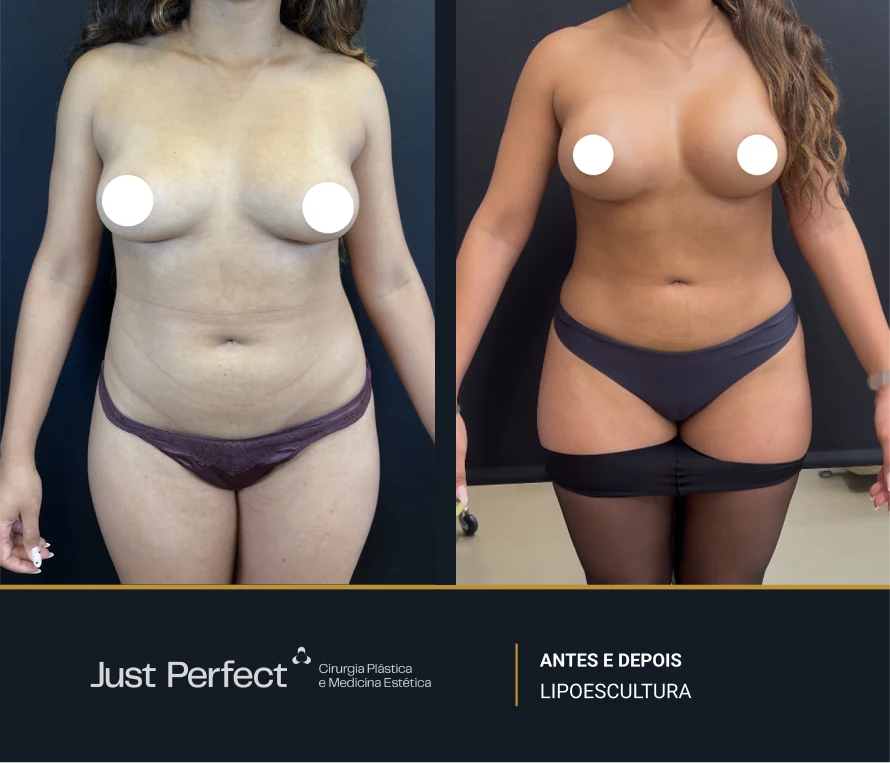 JP_-_antes_e_depois_-_Lipo_2