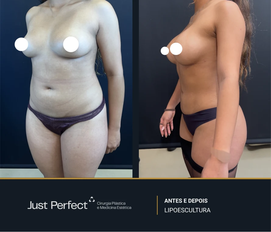 JP_-_antes_e_depois_-_Lipo_3
