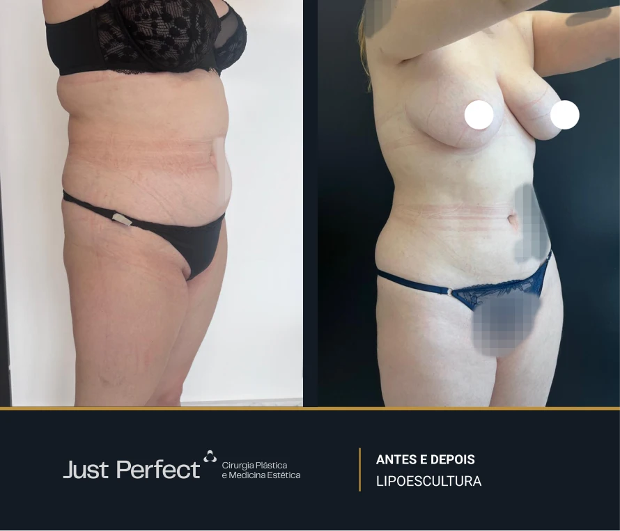 JP_-_antes_e_depois_-_Lipo_6