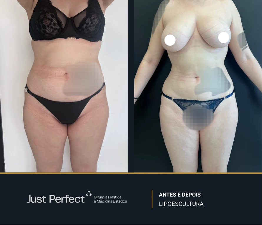 JP_-_antes_e_depois_-_Lipo_7