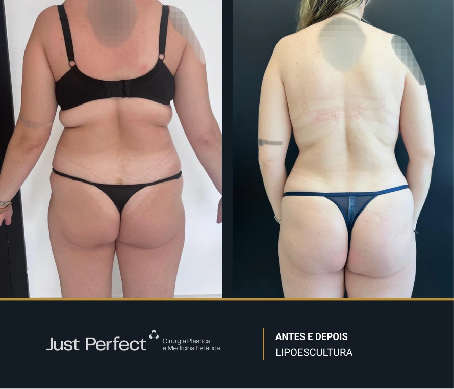 JP_-_antes_e_depois_-_Lipo_8