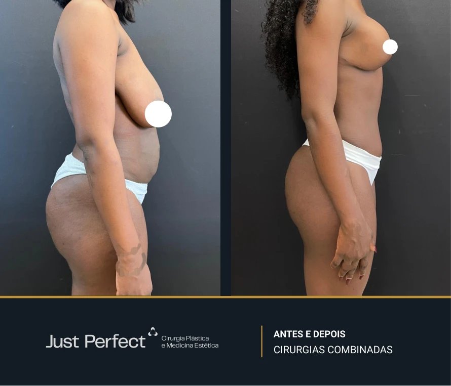 JP_-_antes_e_depois_-_combinadas_1