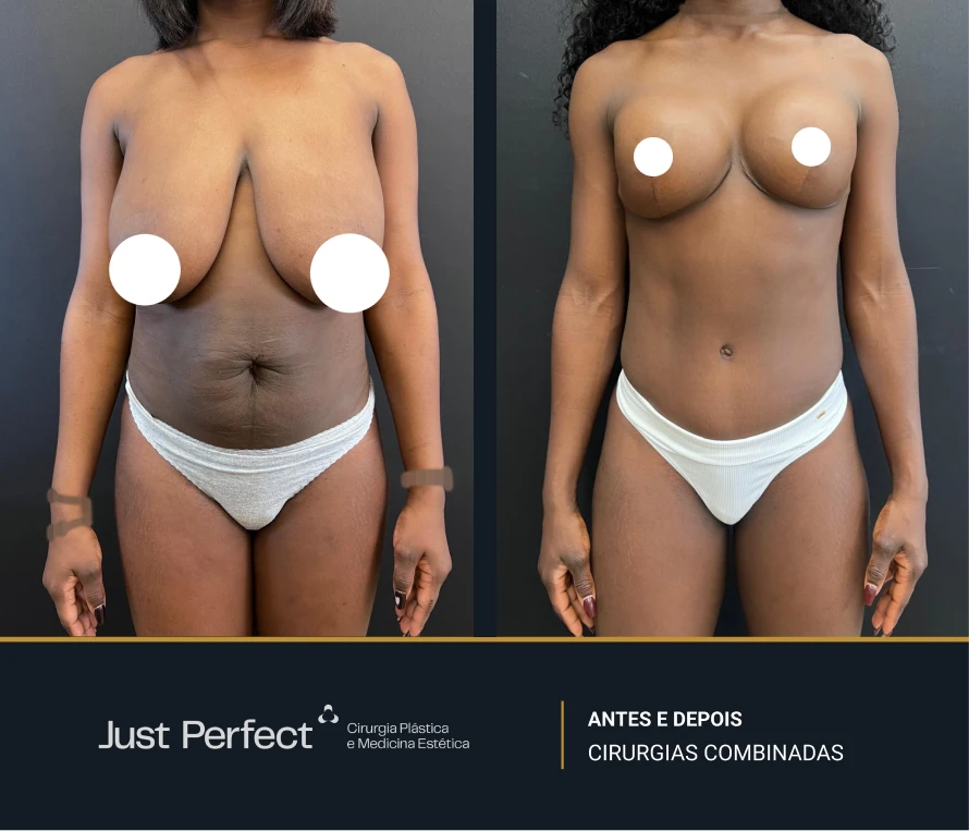 JP_-_antes_e_depois_-_combinadas_3