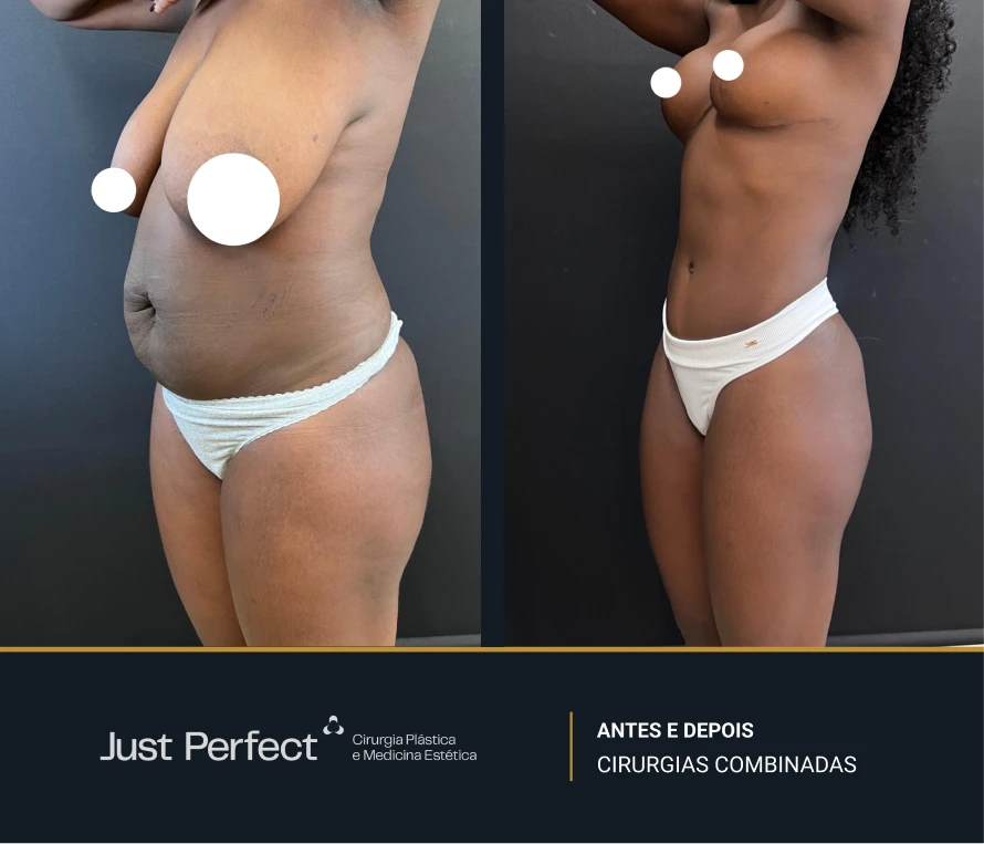 JP_-_antes_e_depois_-_combinadas_6