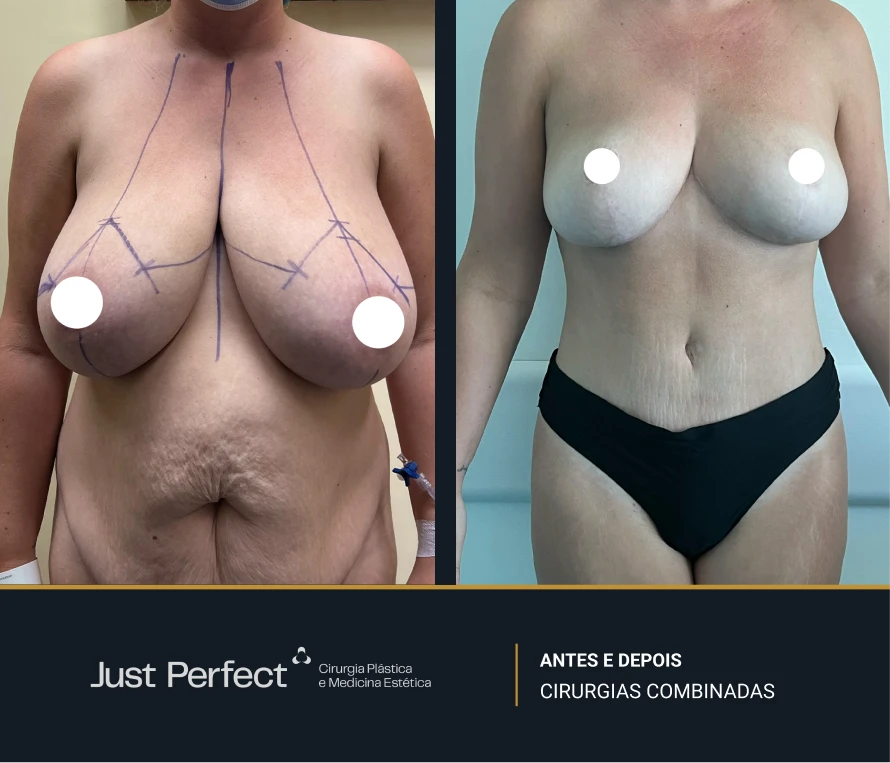 JP_-_antes_e_depois_-_combinadas_7