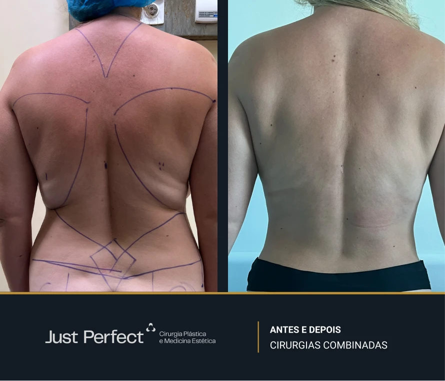 JP_-_antes_e_depois_-_combinadas_9