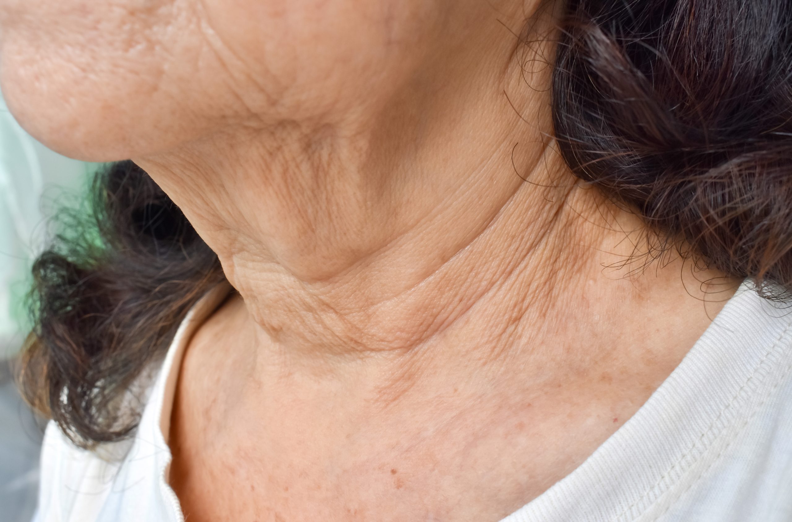 Aging skin folds or skin creases or wrinkles at neck of Southeast Asian, Chinese elderly woman.