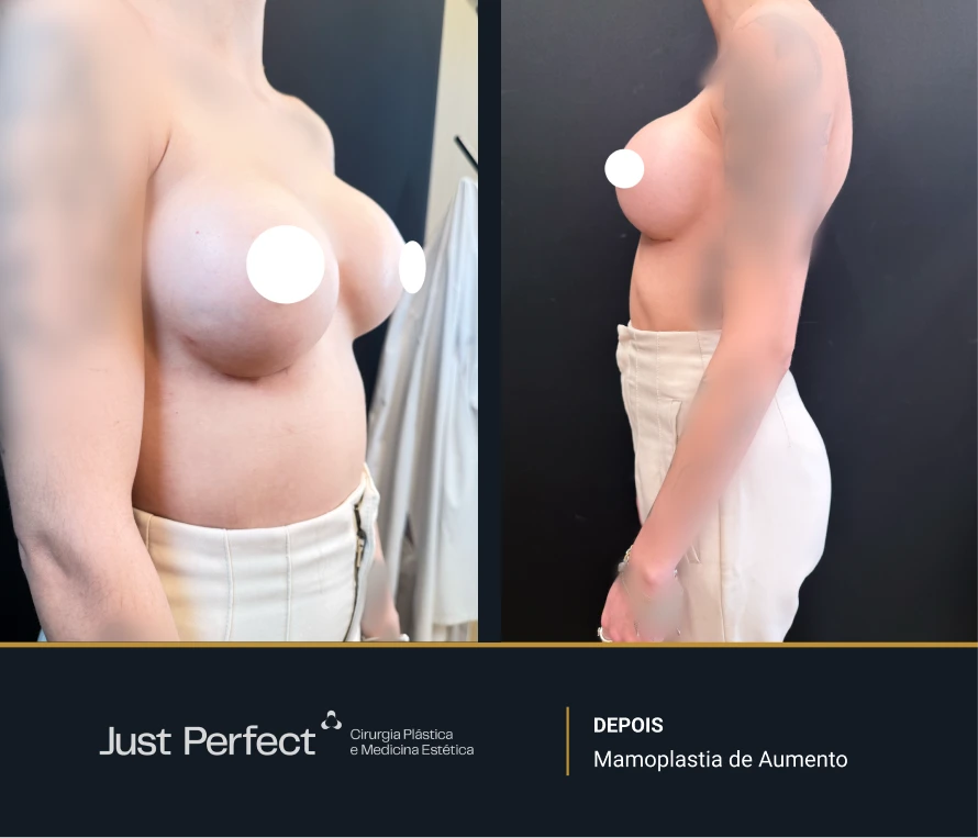 JP - antes e depois - Mamoplastia de Aumento 9