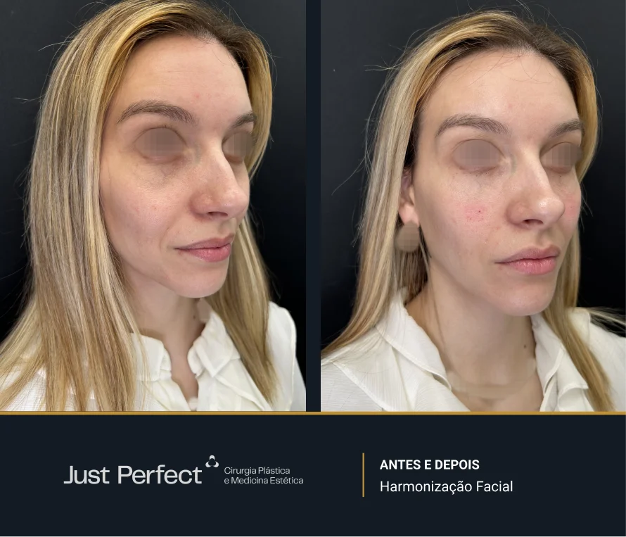 JP_-_antes_e_depois_-_Harmonizao_facial_2