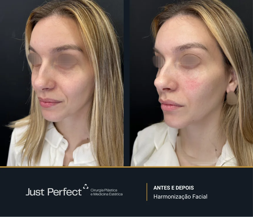 JP_-_antes_e_depois_-_Harmonizao_facial_4