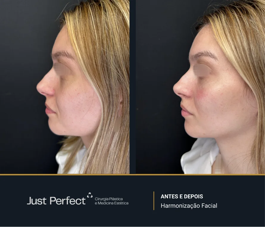 JP_-_antes_e_depois_-_Harmonizao_facial_5