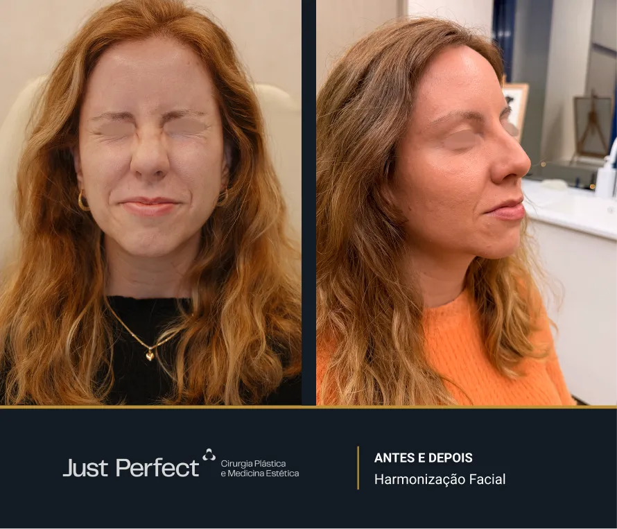 JP_-_antes_e_depois_-_Harmonizao_facial_6