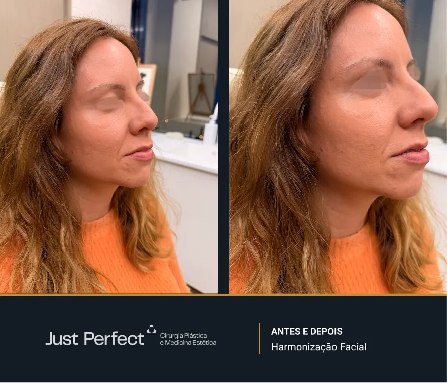 JP_-_antes_e_depois_-_Harmonizao_facial_7