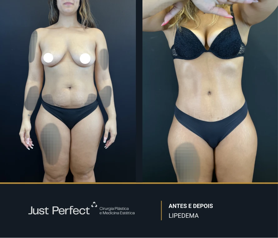 JP_-_antes_e_depois_-_LIPEDEMA_3