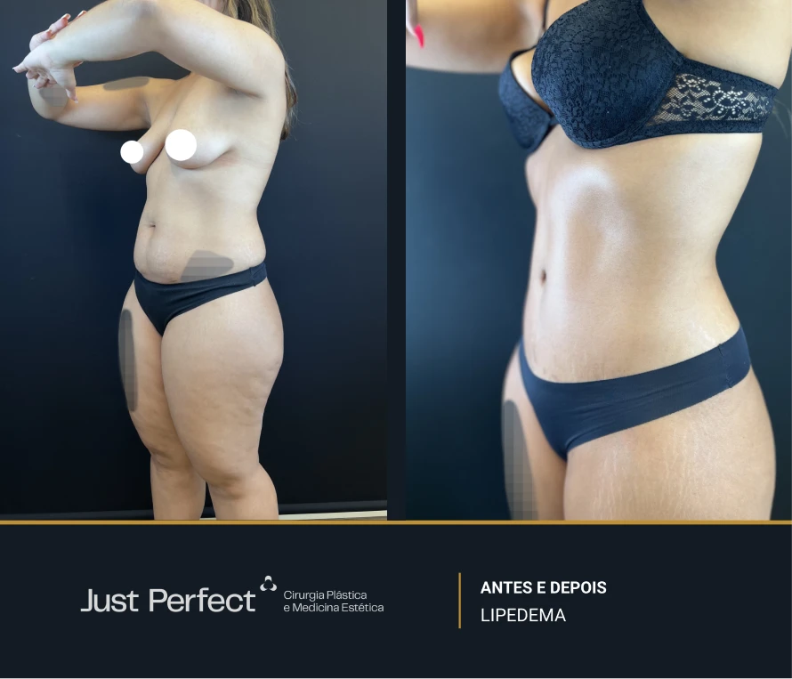 JP_-_antes_e_depois_-_LIPEDEMA_7