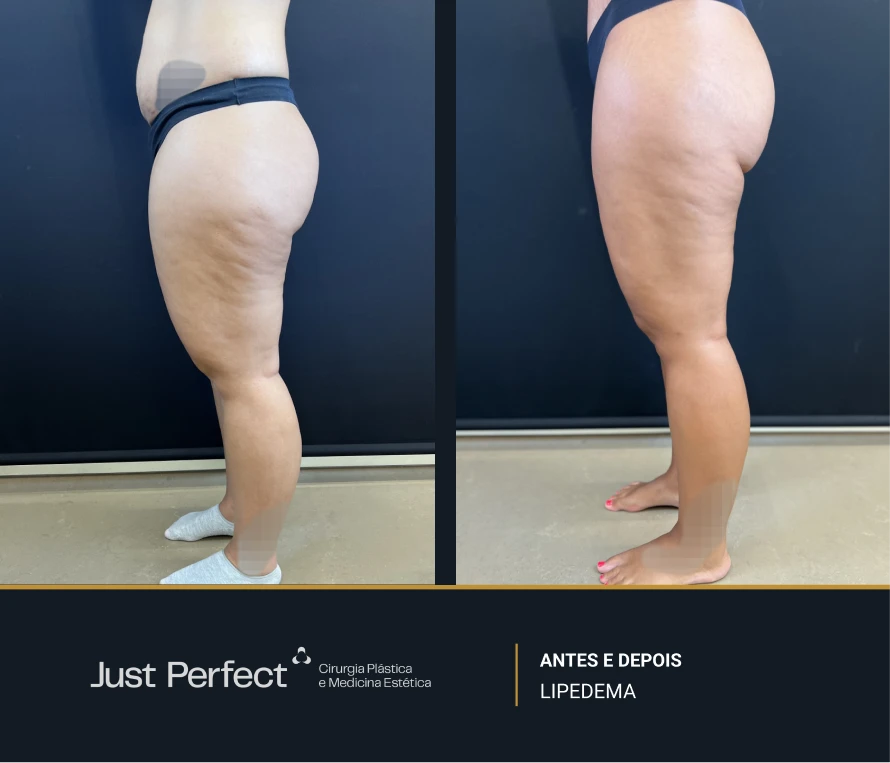 JP_-_antes_e_depois_-_LIPEDEMA_9