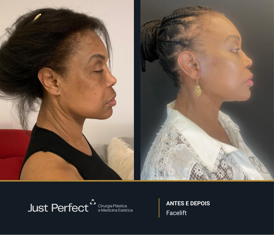 JP_-_antes_e_depois_-_facelift_01