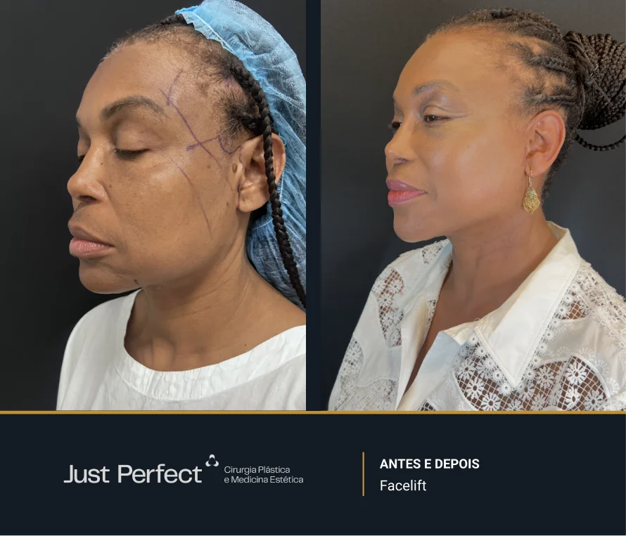 JP_-_antes_e_depois_-_facelift_3