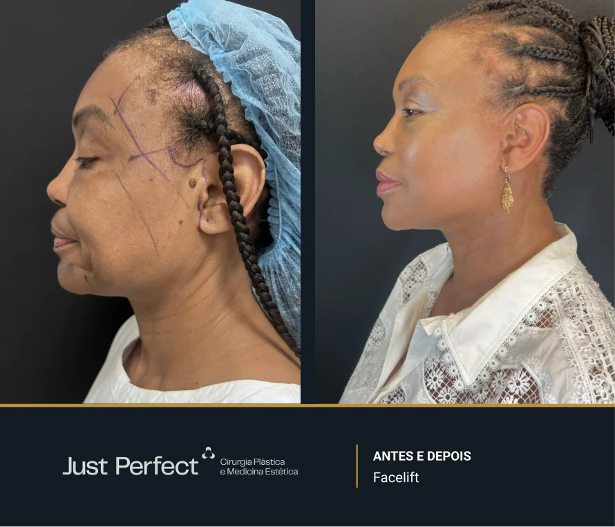 JP_-_antes_e_depois_-_facelift_4