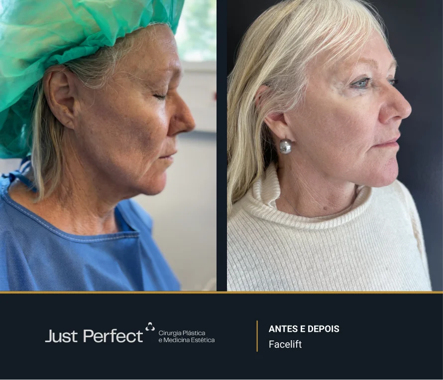 JP_-_antes_e_depois_-_facelift_7