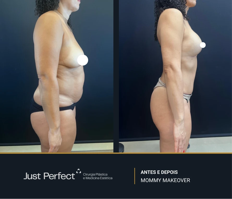 JP_-_antes_e_depois_-_Mommy_10