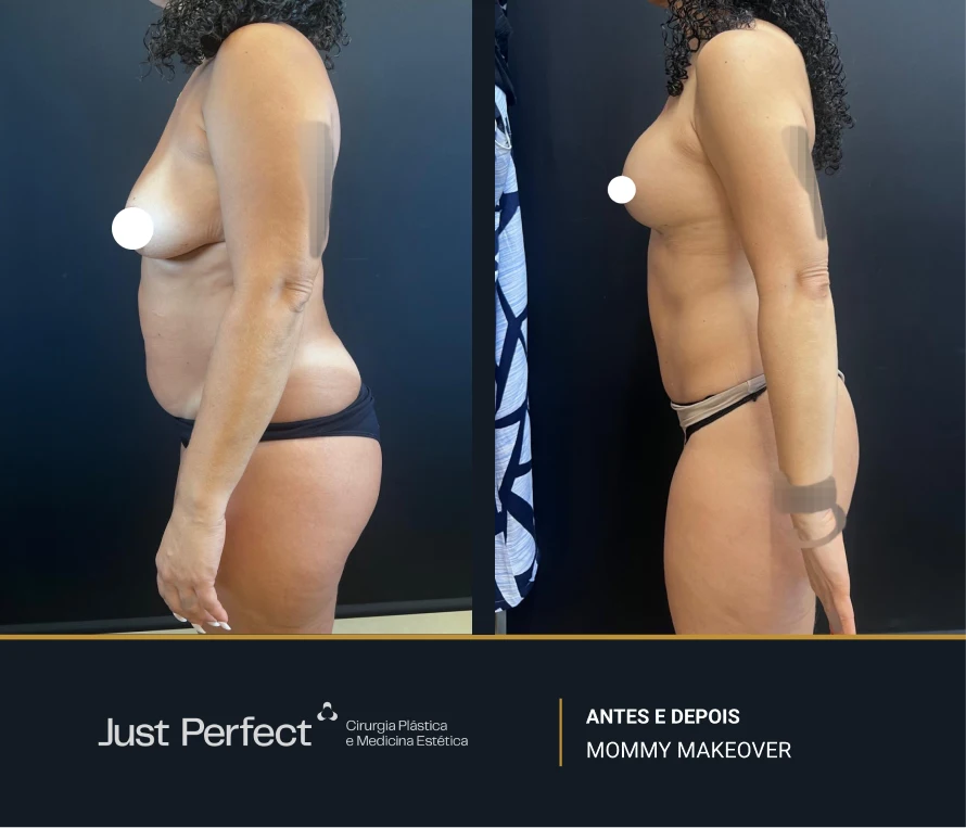 JP_-_antes_e_depois_-_Mommy_15