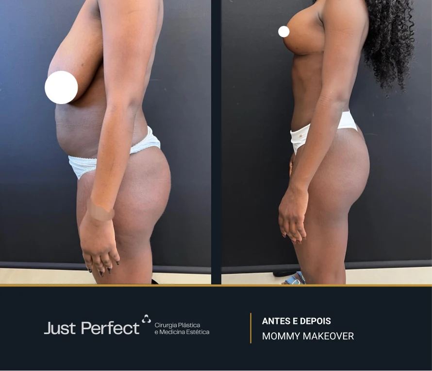 JP_-_antes_e_depois_-_Mommy_8