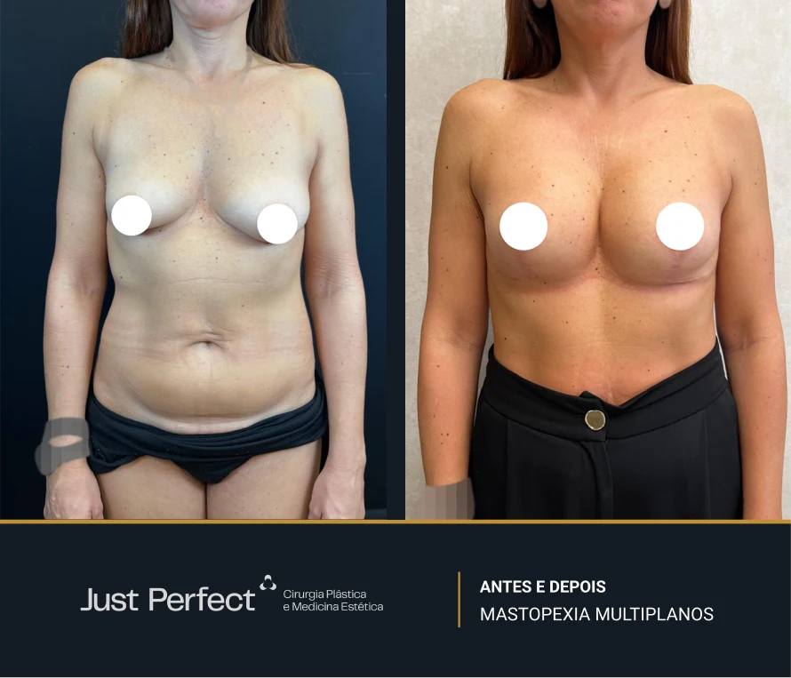 JP_-_antes_e_depois_-_masto_3