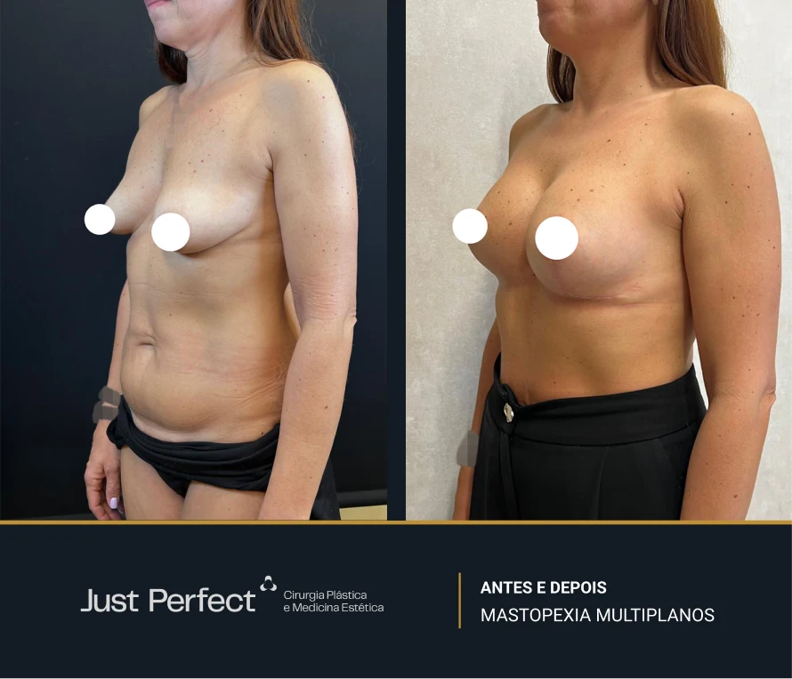 JP_-_antes_e_depois_-_masto_4