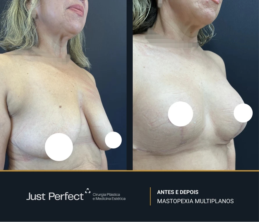 JP_-_antes_e_depois_-_masto_7