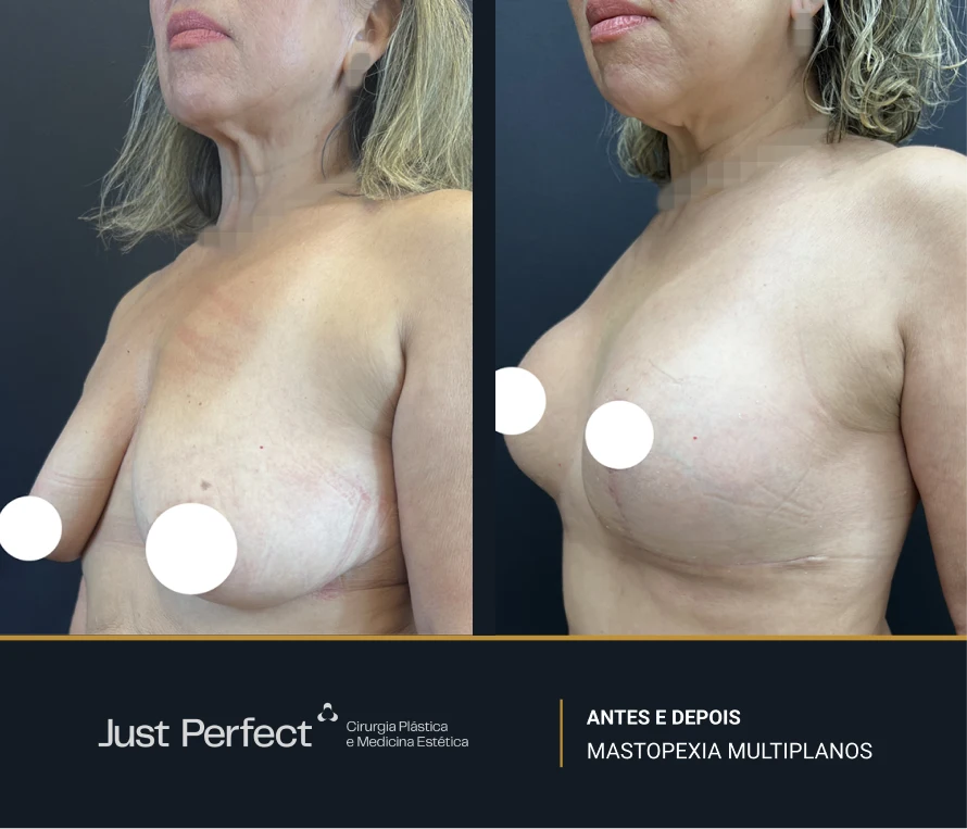 JP_-_antes_e_depois_-_masto_9